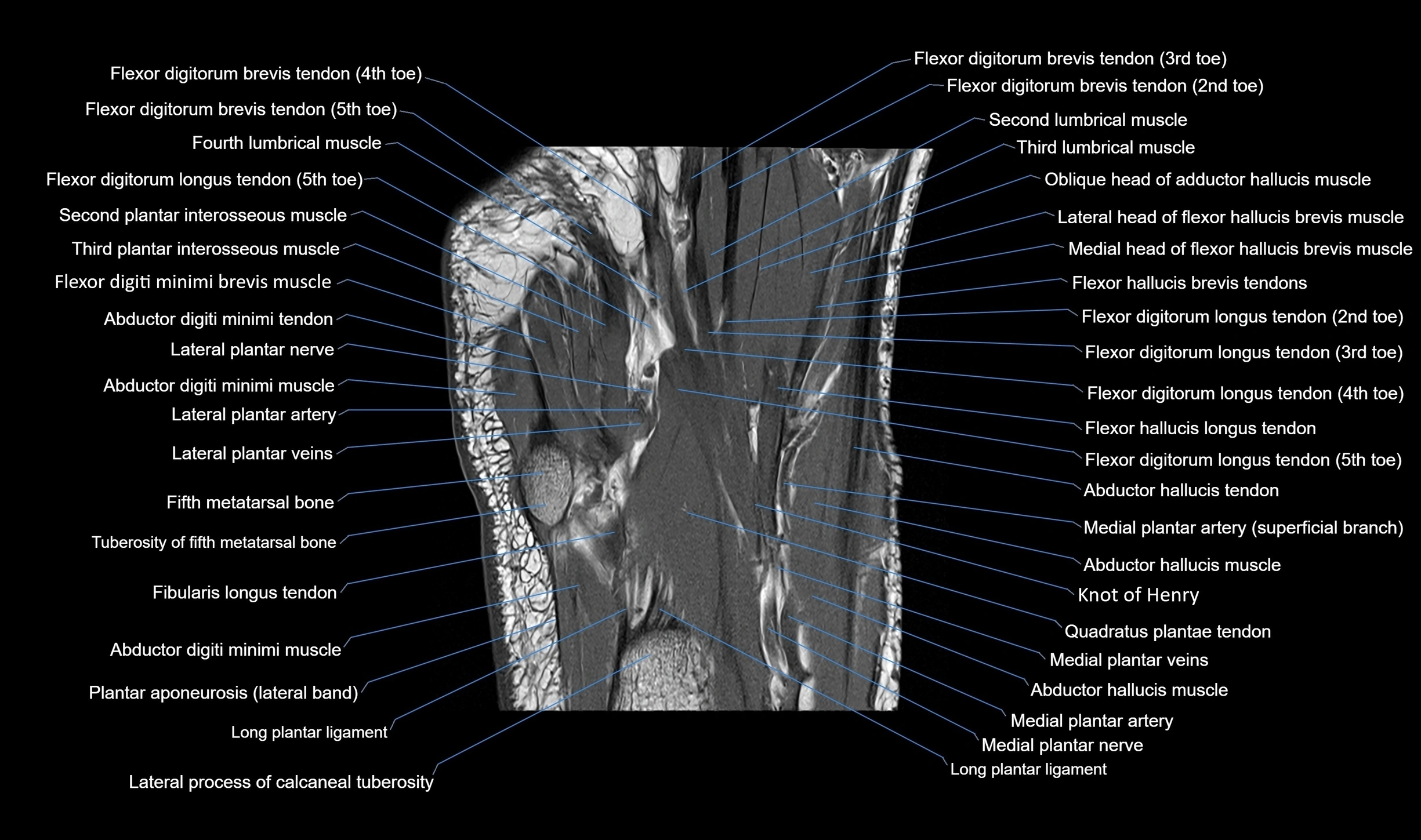 MRI mid foot coronal ligaments cross sectional anatomy 3T  radiology  image-img-00001-00031.webp